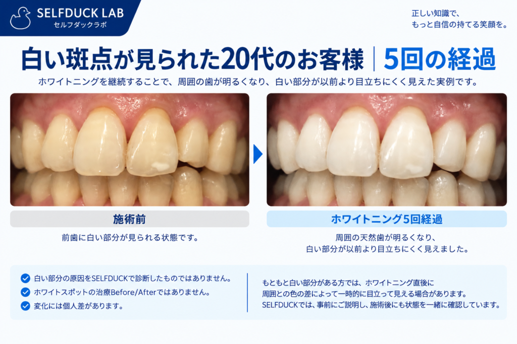 白い斑点が見られた20代のお客様|5回の経過