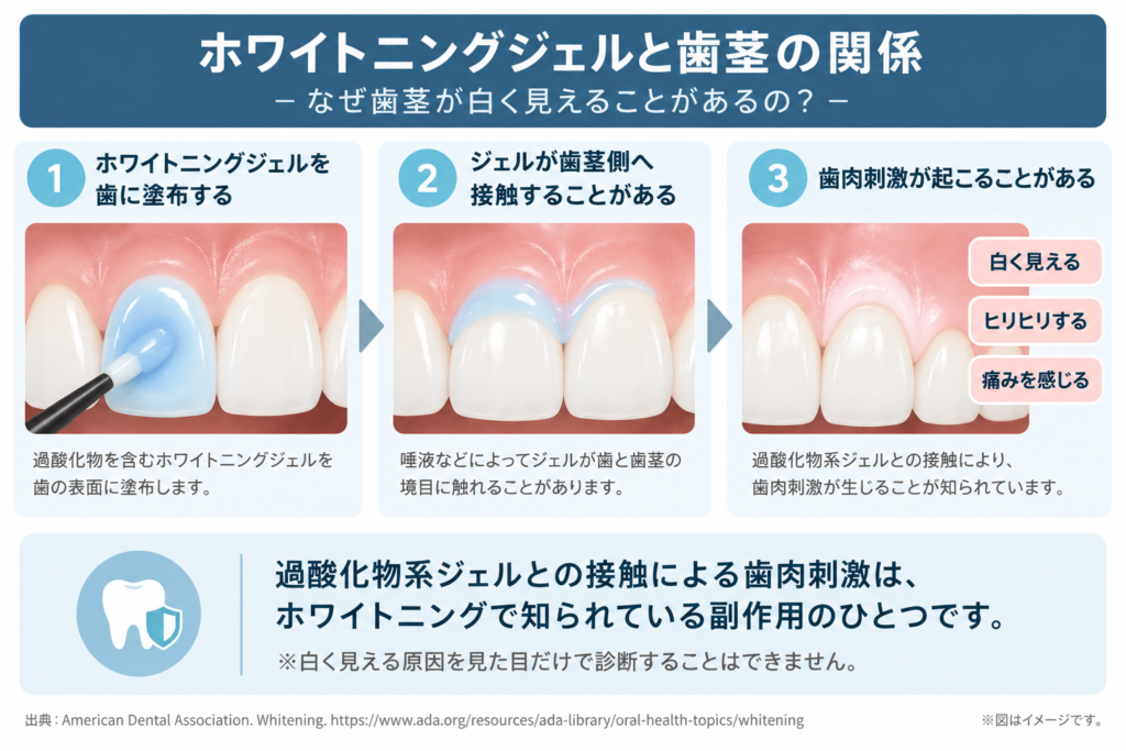 ホワイトニングジェルが歯茎に接触し、白く見える・ヒリヒリするなどの歯肉刺激が起こる仕組み