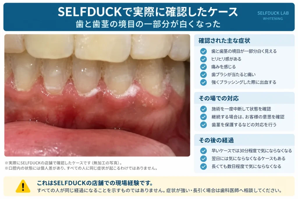 SELFDUCKでホワイトニング後に歯と歯茎の境目が部分的に白くなった実際のケース