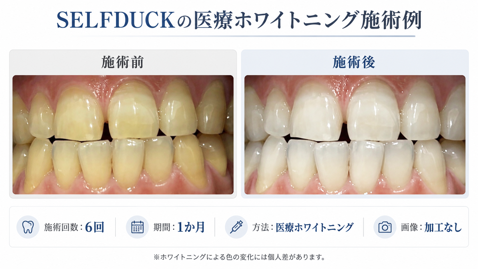 SELFDUCKで医療ホワイトニングを1か月間に6回行った前後の歯の色の変化を比較した症例写真